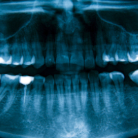 X-ray image of human teeth showing composite filling