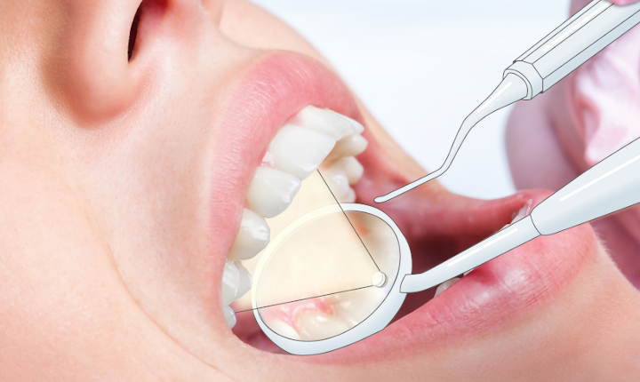 Illustration of a female patient having her teeth examined by a dentist