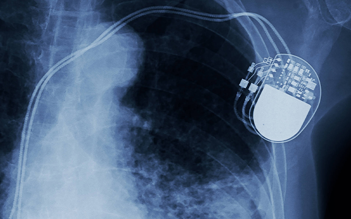 Active medical implant protected by SCHOTT Primoceler® glass packaging