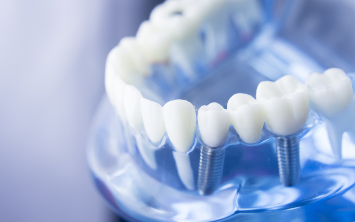 SCHOTT glass powders for safe, secure and attractive dental implants 